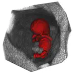Case C: Novel Volumetric Biomarkers for First Trimester Pregnancies Assessed using 3D Ultrasound